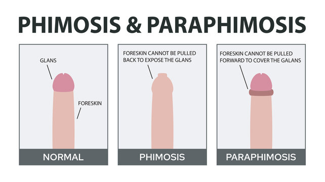 Phimosis and Paraphimosis in Children: What Parents Need to Know
